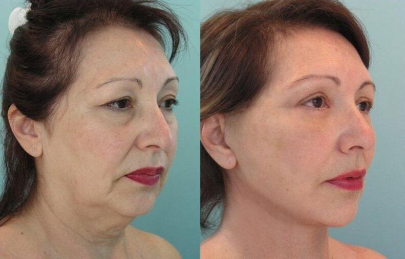 As a result of rejuvenating facial skin tightening with threads