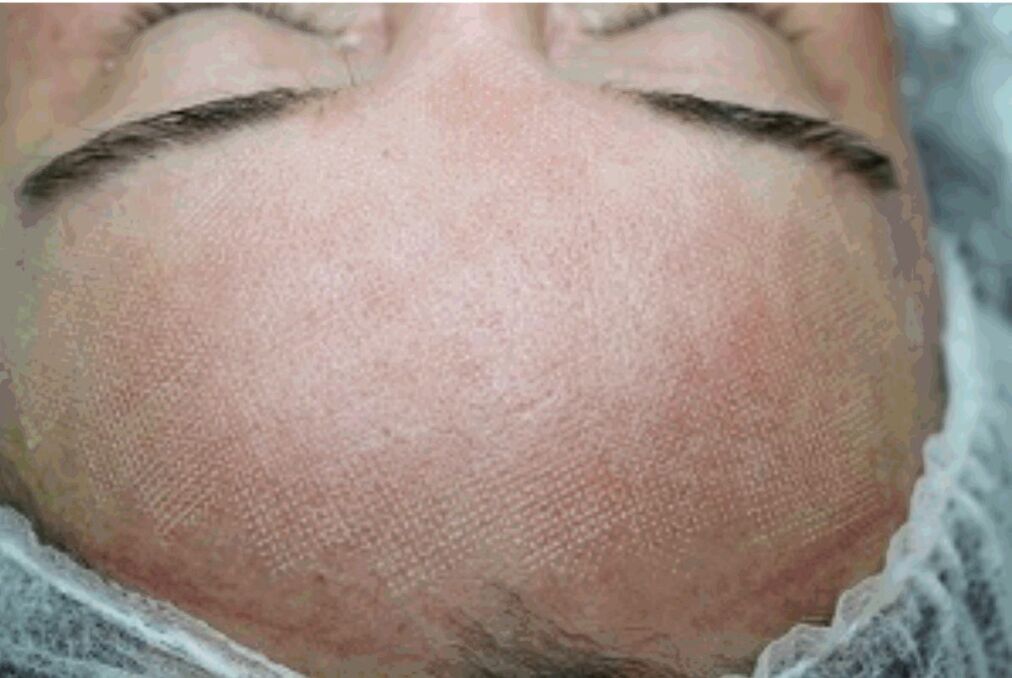 Slight redness and swelling of the skin after a fractional laser