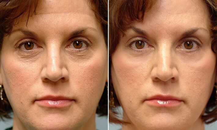 face before and after laser fractional renewal