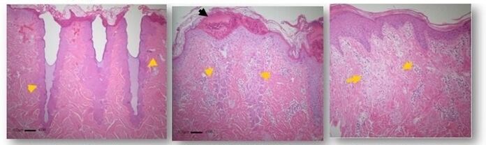 skin change under a microscope after fractional renewal