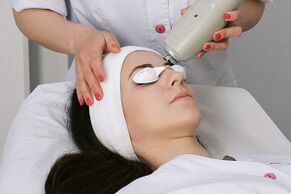 the procedure for carrying out laser fractional renewal
